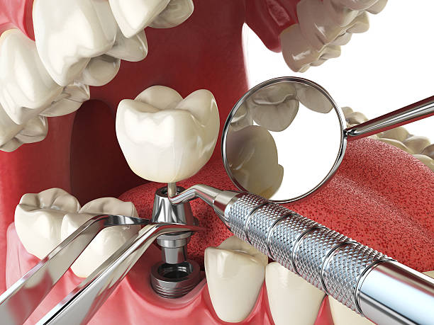 Best Chipped Tooth Repair Near Me  in Intercourse, PA